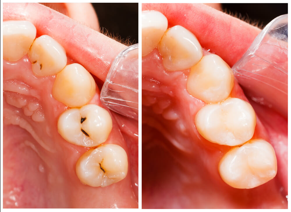 A comparison of tooth colored fillings to silver fillings on the teeth