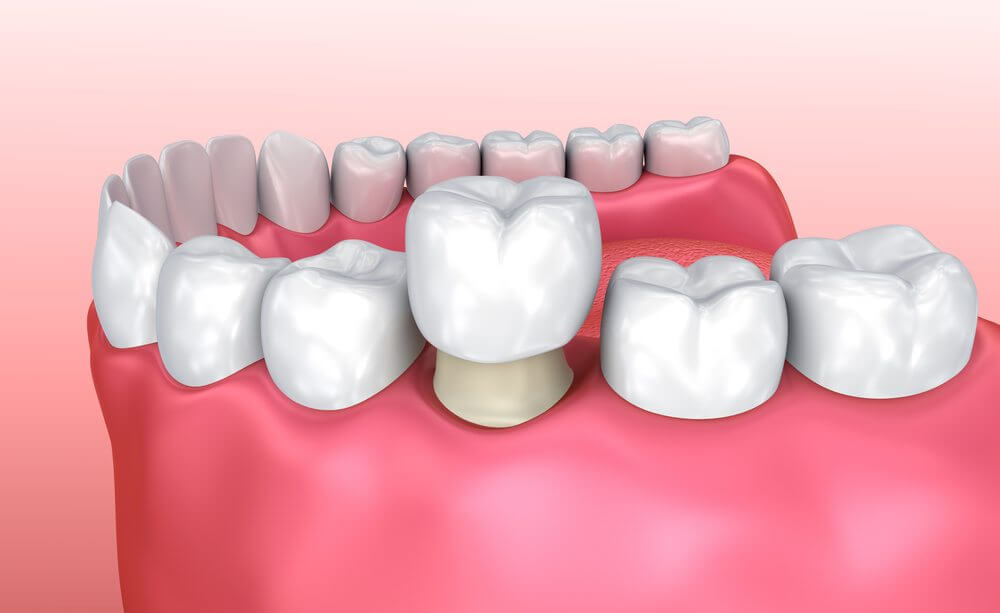 A computer generated image of what dental crowns look like in the mouth