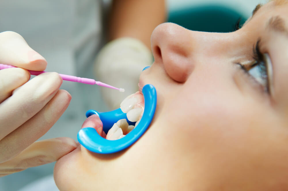 A younger child getting dental sealants placed on their teeth